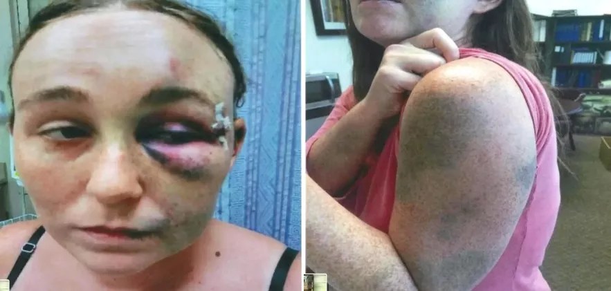 Woman Says Fort Lauderdale-Area Cops Beat Her After She Testified in Brutality Case