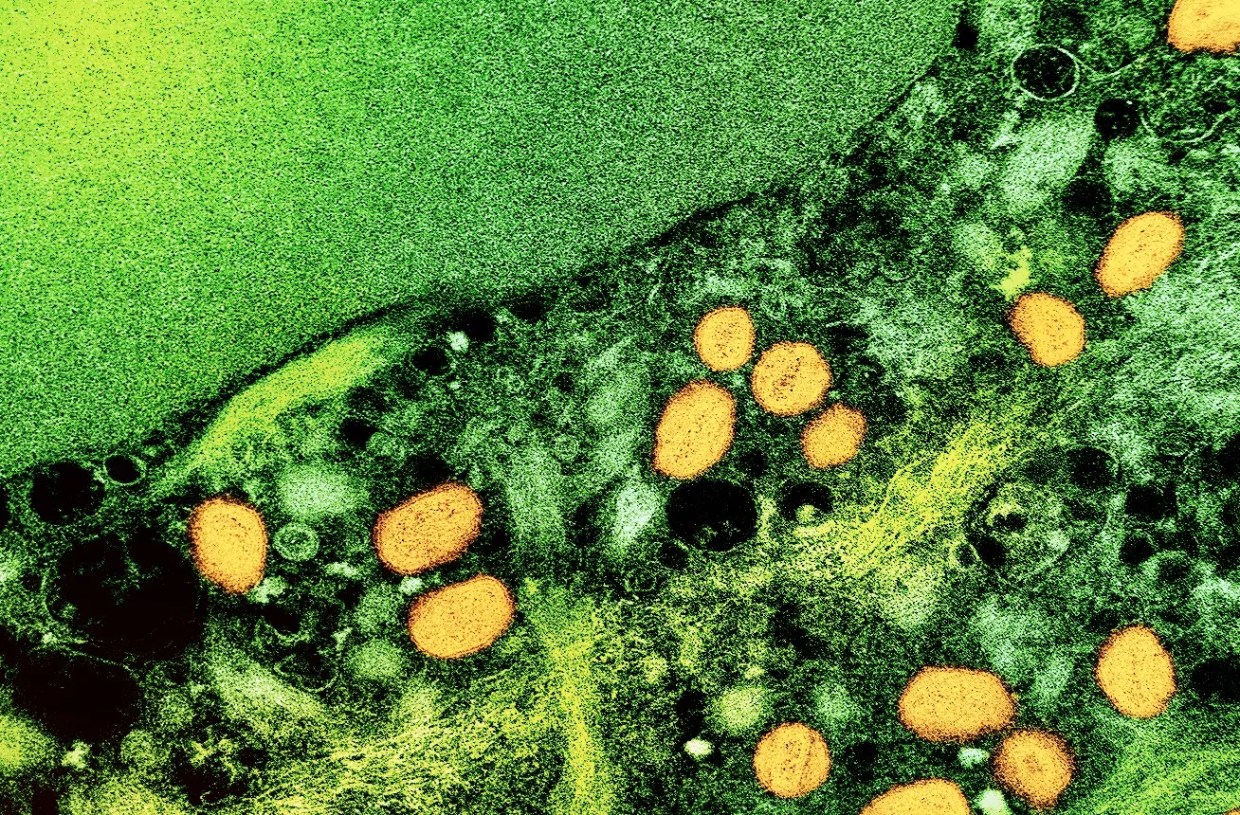 Monkeypox Arrives in Miami-Dade County Jails