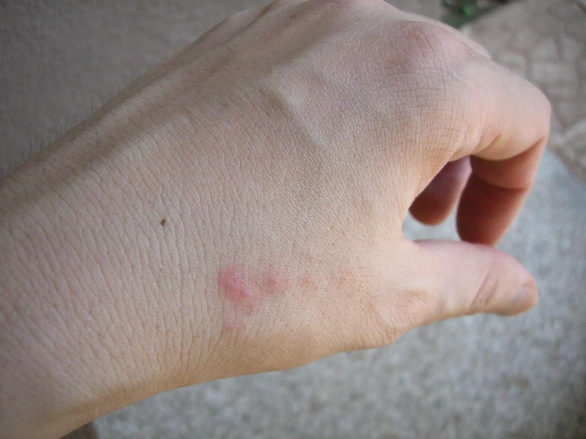 a hand with red bug bites on it