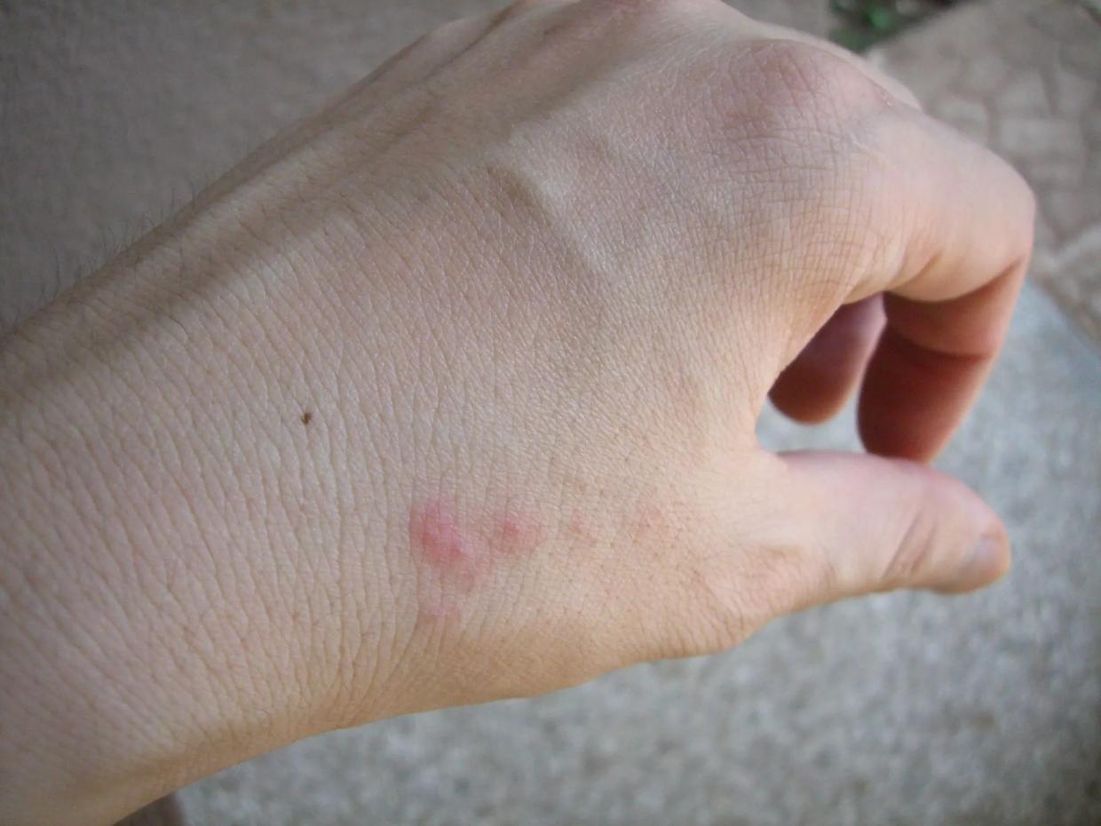 a hand with red bug bites on it